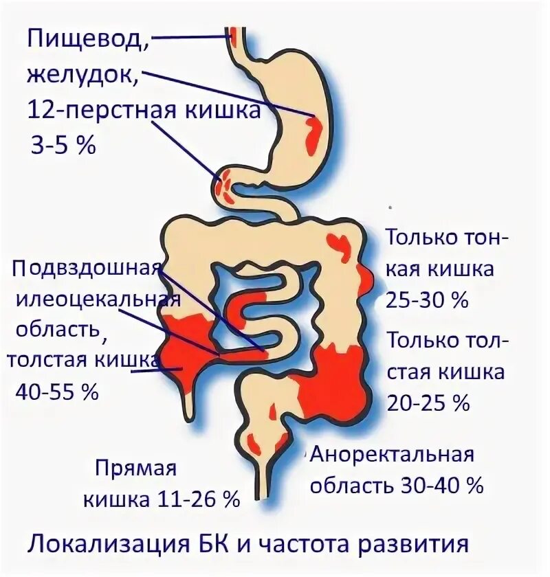 Илеоколит. Болезнь крона терминальный илеит. Катаральный терминальный илеит. Илеит терминальный кишечника.