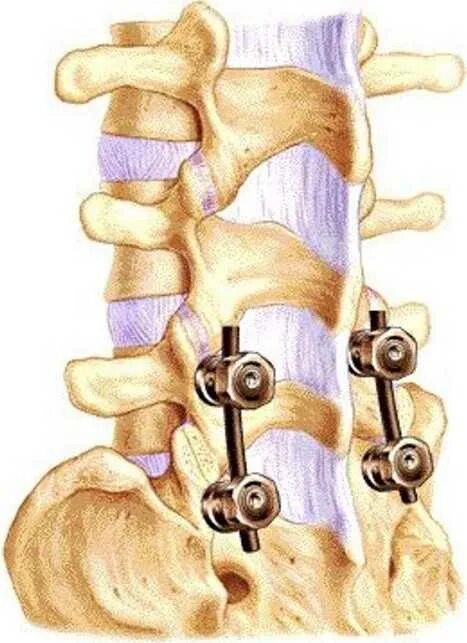 Транспедикулярная фиксация l5-s1 позвонков. Транспедикулярная фиксация позвоночника l5-s1. Операция транспедикулярная фиксация позвоночника. Спондилодез l5 s1 Кейджем. Операция фиксация позвоночника