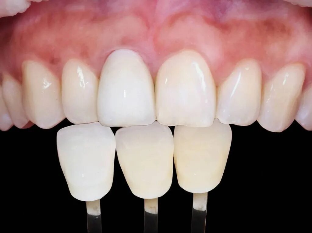 Керамические виниры обточка. Коронки или виниры на передние. Коронки или виниры на передние. Коронки или виниры на передние. Керамические виниры emax.