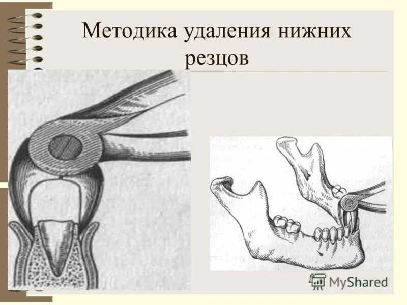 Удаление верхних резцов. Удалить резцы. Имплантаты в области нижних резцов. Верхние центр. Зубы резцы клыки премоляры моляры.