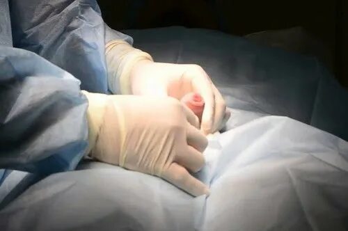 Закрытая плоть. Схема обрезания крайней плоти. Фимоз 4 степени у ребенка 4 года. Закрытая плоть. Операция обрезание крайней плоти , фимоза.