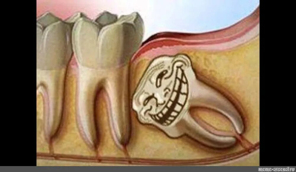 Вырывание коренного зуба. Удаленный коренной зуб.