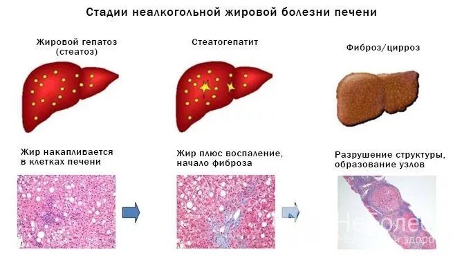 Жировое увеличение печени. Жировой гепатоз классификация. Жировое Перерождение печени (жировой гепатоз). Неалкогольный жировой гепатоз печени. Жировая инфильтрация печени 3 степени.