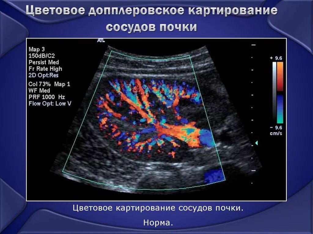 Доплер почек. Цветовое допплеровское картирование ЦДК. Ультразвуковая допплерография сосудов почек. Допплер сосудов почек показатели. УЗИ почек допплер сосудов почек.