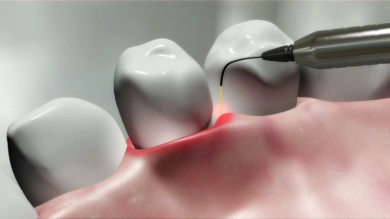 Лазер в хирургической стоматологии. Хирургическая ретракция десны. Лазерная терапия в стоматологии. Лазерное десен