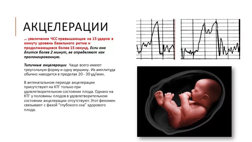 Акселерации децелерации КТГ плода. Акцелераций спорадические на КТГ. КТГ норма акселерации. Норма ЧСС плода на КТГ. Сердцебиение в 13 недель