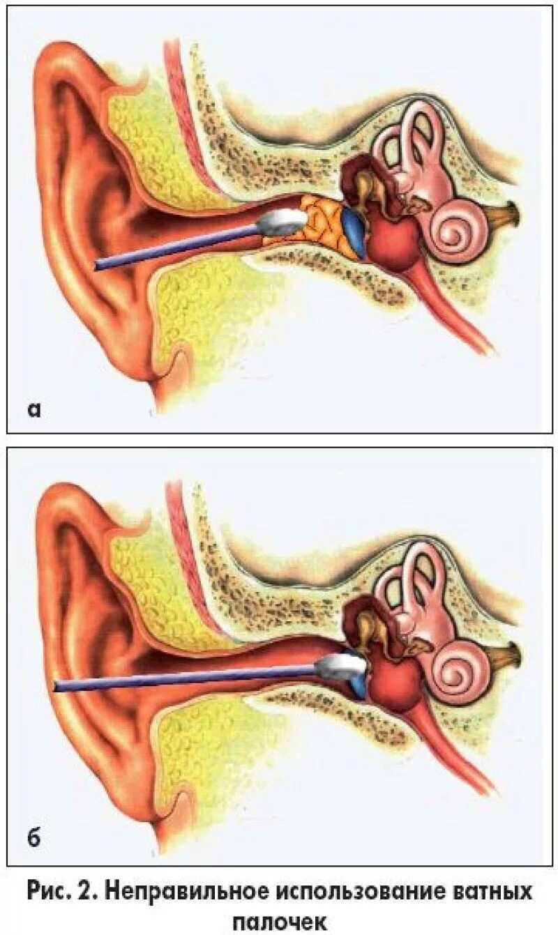 Заложило ухо ватной палочкой что делать. Серная пробка наружного слухового прохода. Анатомия уха серная пробка. Серная пробка ватные палочки.