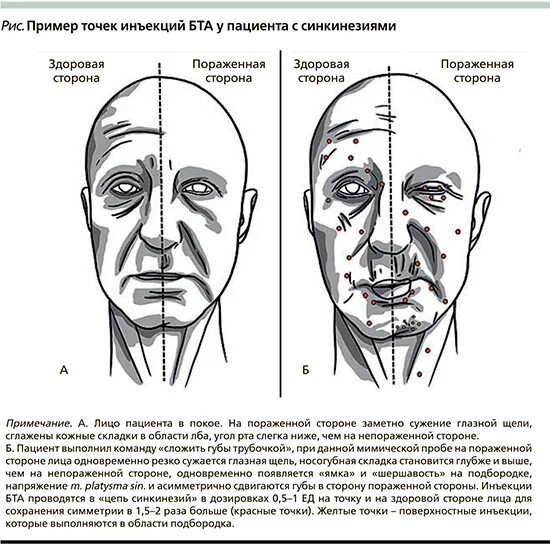 Укол точка голода отзывы. Патологические синкинезии неврология. Синкинезии лицевой мускулатуры. Возрастные изменения мышц лица. Синкинезии это в неврологии.
