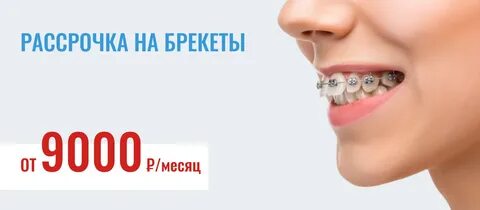 Сколько стоят брекеты в барнауле