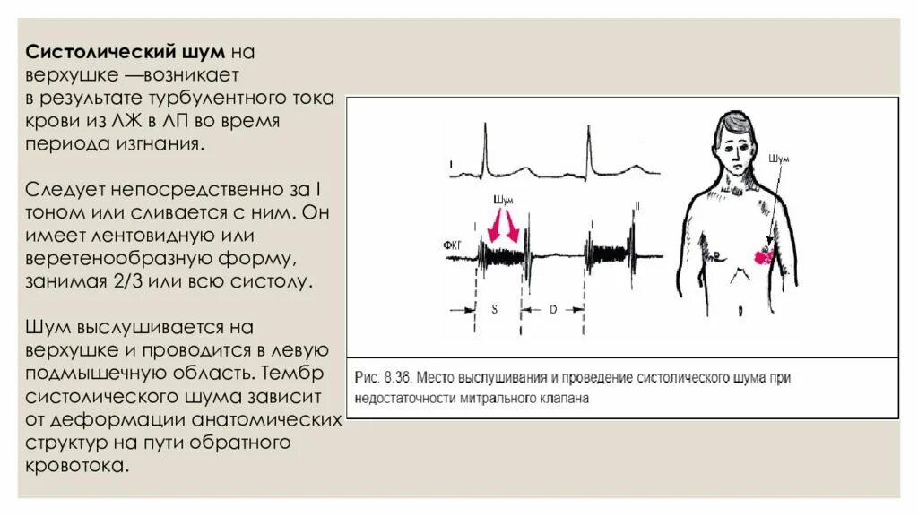 Тоны сердца приглушены систолический шум это. Механизм образования систолического шума сердца. Механизм образования систолического шума у детей. Аускультация сердца систолический шум. Систолический шум это