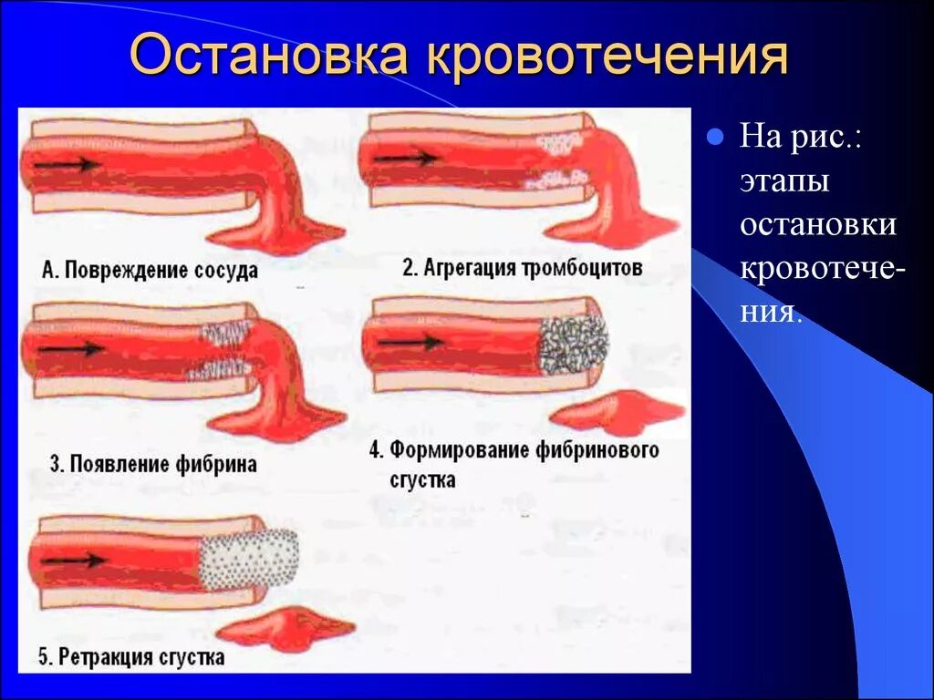 Гемостаз остановка кровотечения. Фазы остановки кровотечения. Остановкакровотеечния. Этапы останавливания кровотечения.