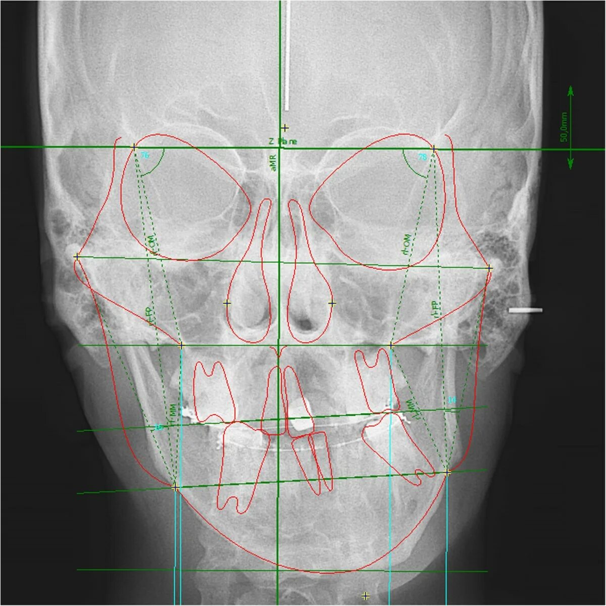Широкая кость лица. Асимметрия лица. Асимметрия лица анатомия. Несимметричное лицо.