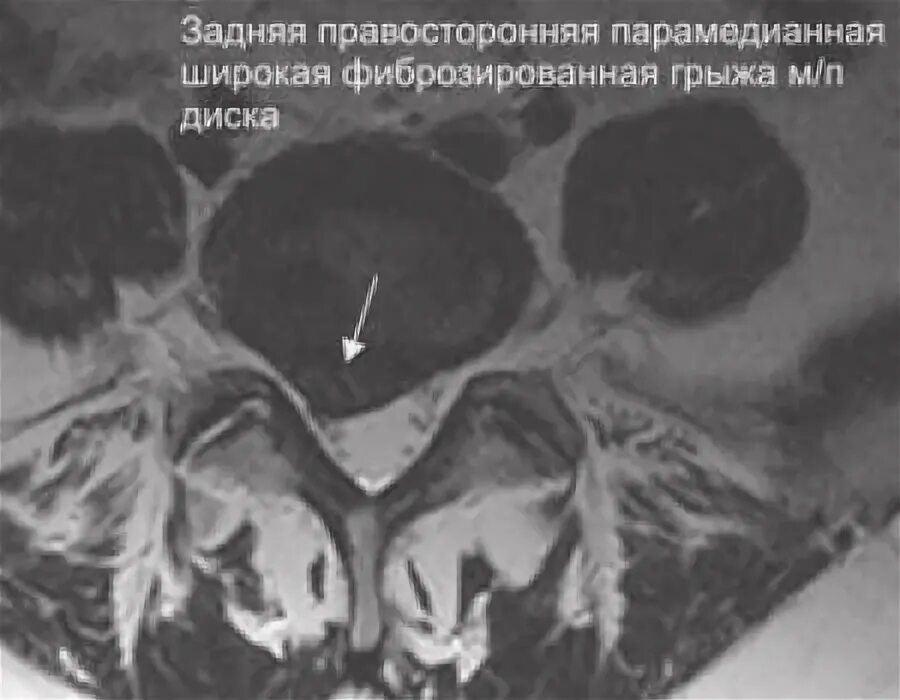 Может ли рассосаться грыжа. Правосторонняя парамедианная грыжа. парамедианная грыжа диска. могут ли рассосаться грыжа позвоночника.