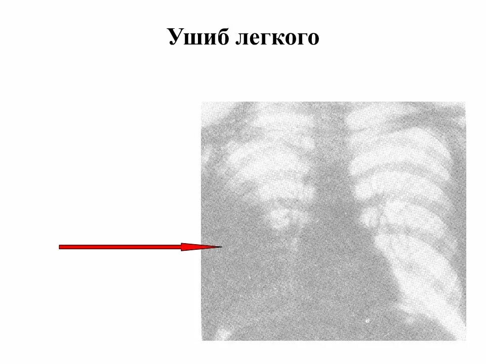 Гематома легкого рентген. Ушиб легкого на рентгенограмме. Закрытая травма легкого