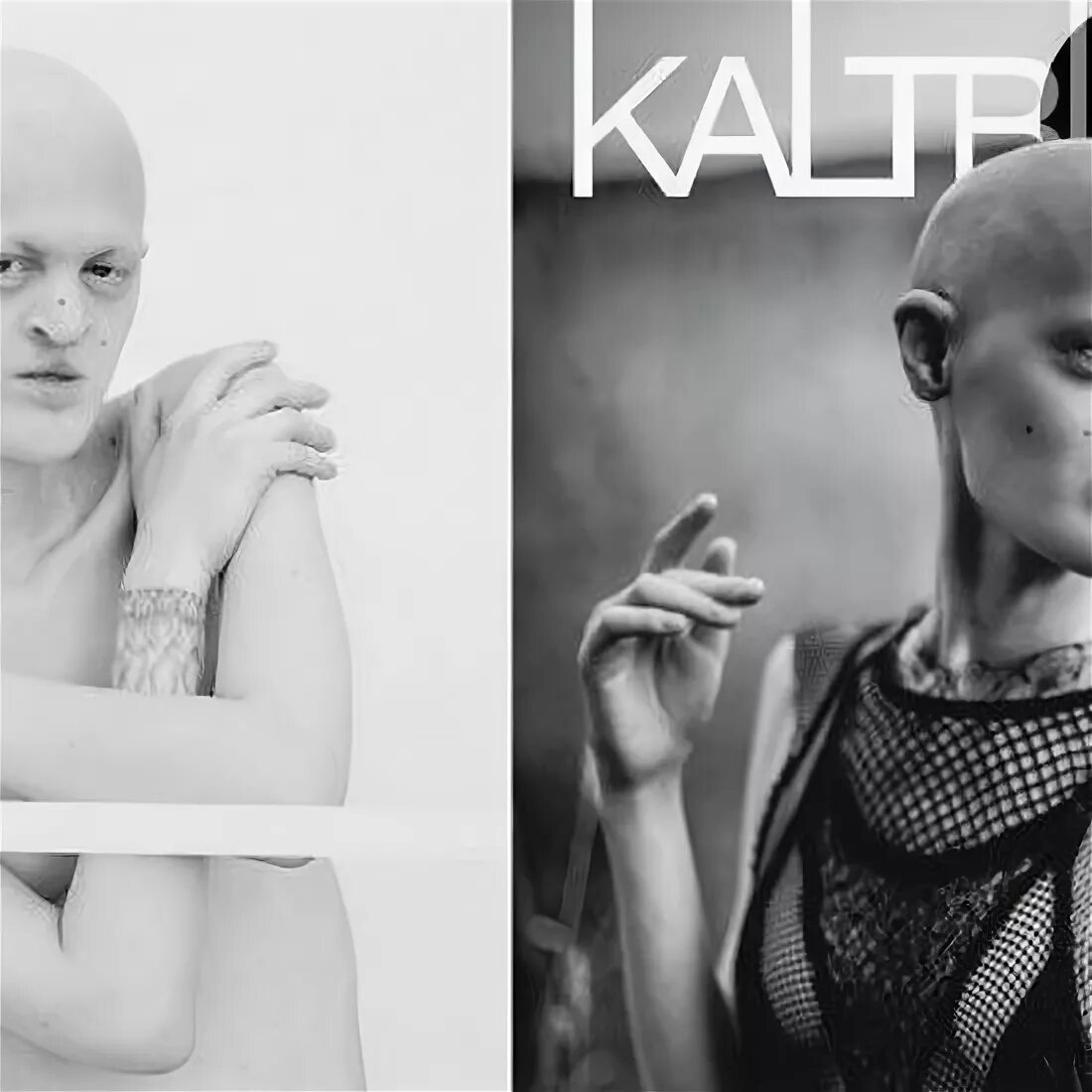 синдром криста сименса турена. эктодермальная дисплазия мелани. гипогидротической эктодермальной дисплазией. ангидротическая эктодермальная дисплазия. мелани гайдос с бойфрендом.