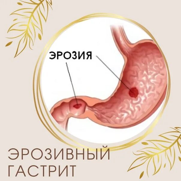 Питание при эрозивном гастрите желудка. Таблица разрешенных продуктов при язве желудка. Список разрешенных продуктов при язве желудка. Облепиховое масло лечебные. Мед при эрозивном гастрите.