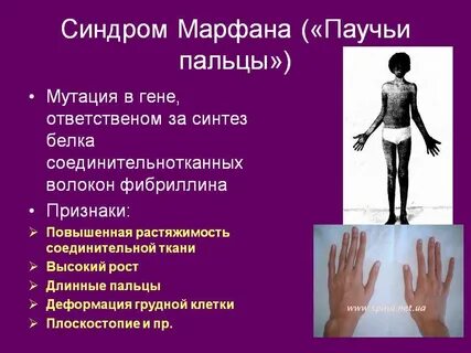 Синдром марфана симптомы