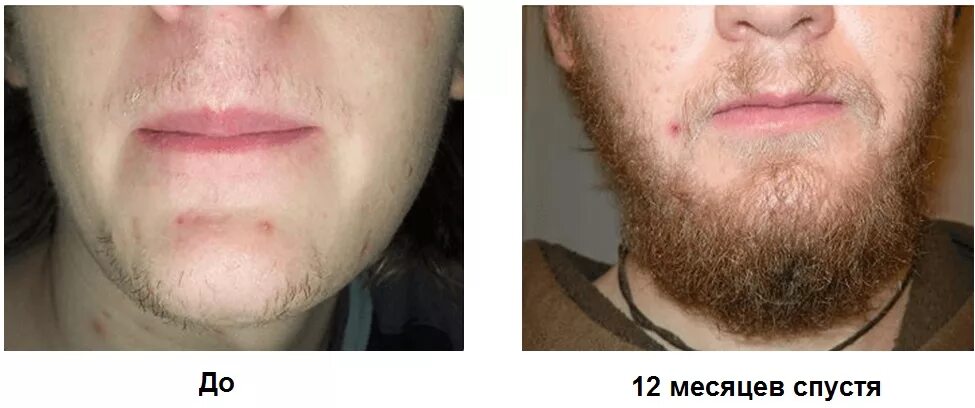 Рост волос на лице у мужчин. Миноксидил для бороды. Средство для роста бороды миноксидил. Миноксидил 5 % alerana для бороды. Масло для роста бороды миноксидил.