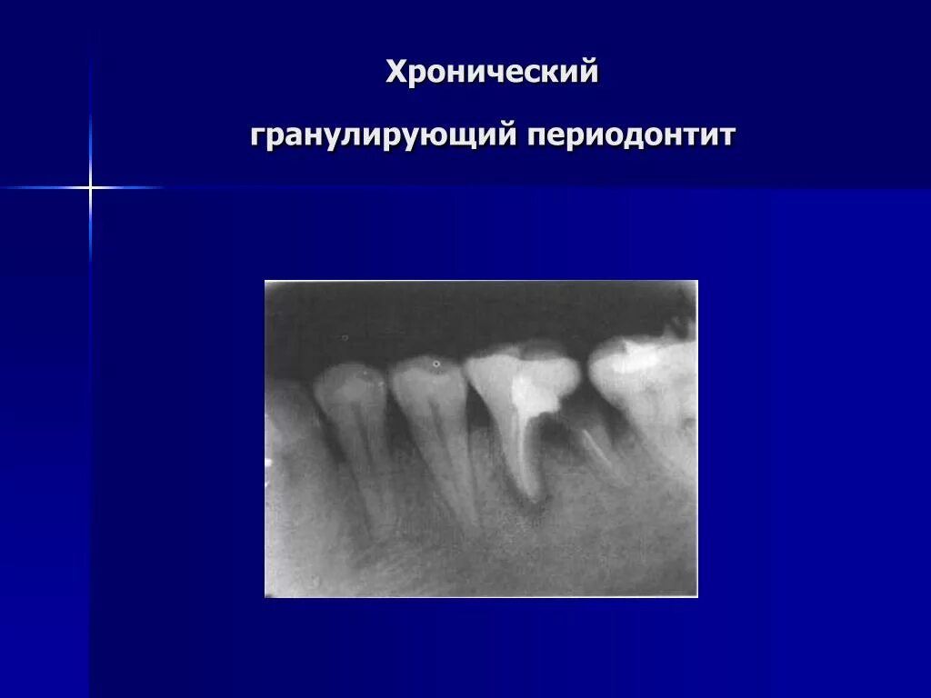 Фиброзный периодонтит. Хронический гранулирующий периодонтит рентген. Хронический апикальный гранулирующий периодонтит. Периодонтит фиброзный гранулематозный гранулирующий. Гранулирующий периодонтит на рентгенограмме.