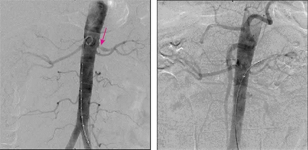 Атеросклероз почечной артерии ангиография. Стеноз почечной артерии ангиограмма. Ангиография окклюзия почечных артерий. Стеноз почечной артерии ангиография. Тромбоз почечной артерии