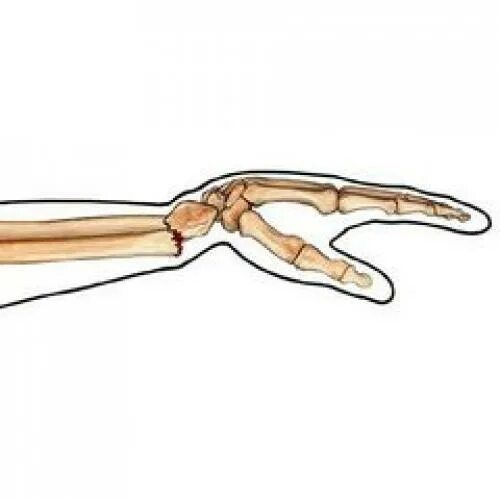 Перелом лучевой запястной кости. Закрытый перелом лучезапястной кости. Лучевая кость на запястье руки перелом. Перелом лучевой кости в типичном месте.