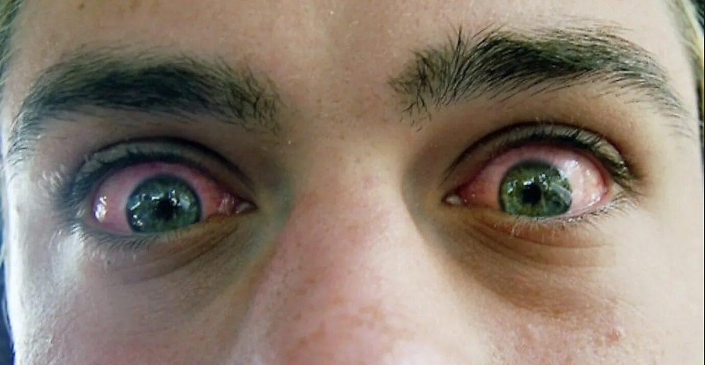 Красные глаза наркомана.