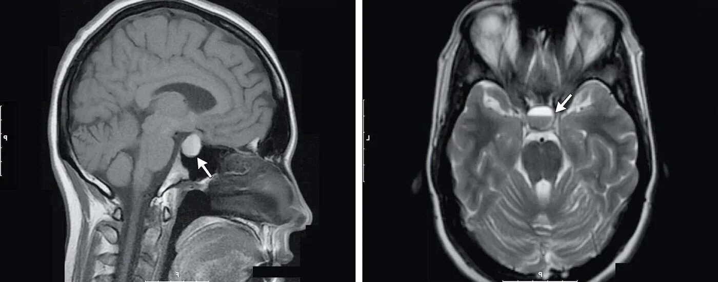Аденома гипофиз мозга что это такое. Микроаденома гипофиза мрт. Аденома гипофиза мрт. Аденома гипофиза кт. Аденома гипофиза снимок мрт.