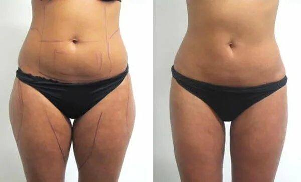 Meet QWO: The First FDA-Approved Injectable for Cellulite