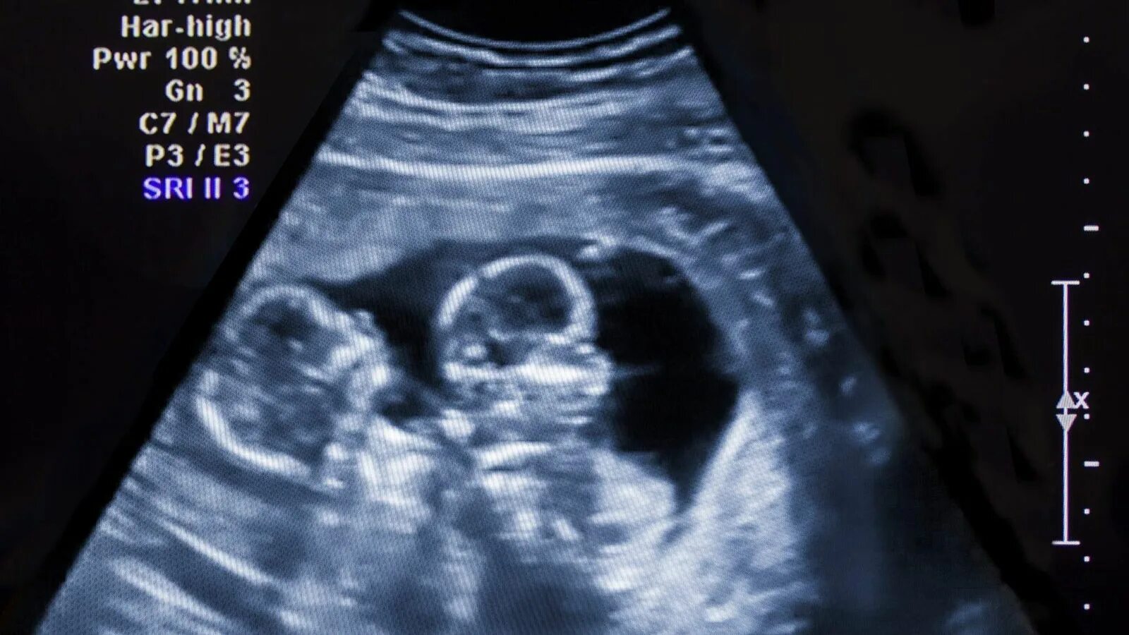 Как выглядят близнецы на узи. Монохориальная двойня узи 7-8 недель. Фото узи двойни на 5 неделе. Узи 17 недель беременности двойня. Как выглядят близнецы на узи.