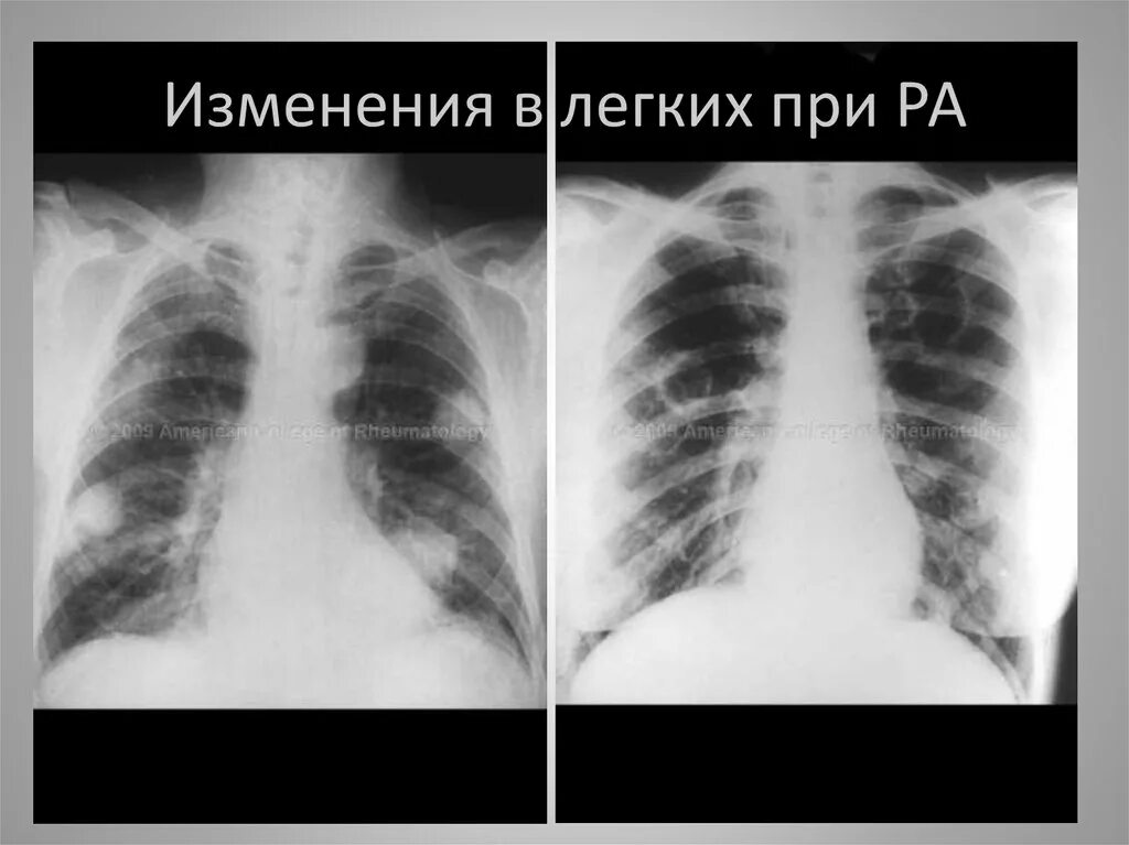 Ревматоидный артрит кт легких. Ревматические узелки в легких рентген. Рентгенография легких при ревматоидном артрите. Ревматоидный артрит легкие кт. Ревматоидный артрит легких