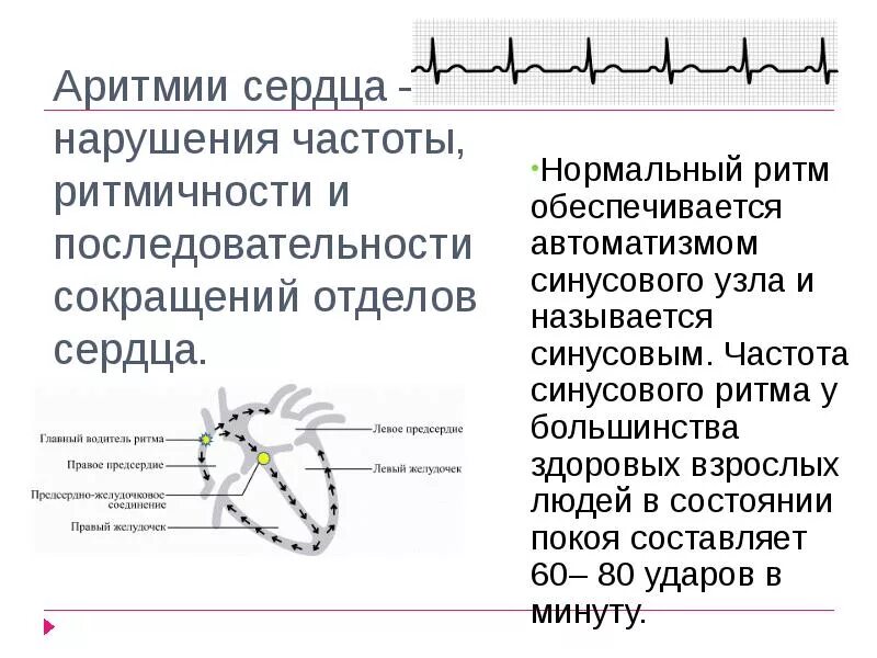 Что покажет аритмию сердца. Аритмия сердца. нарушение ритма сердца название. нормальный ритм сердца и аритмия. аритмия симптомы.
