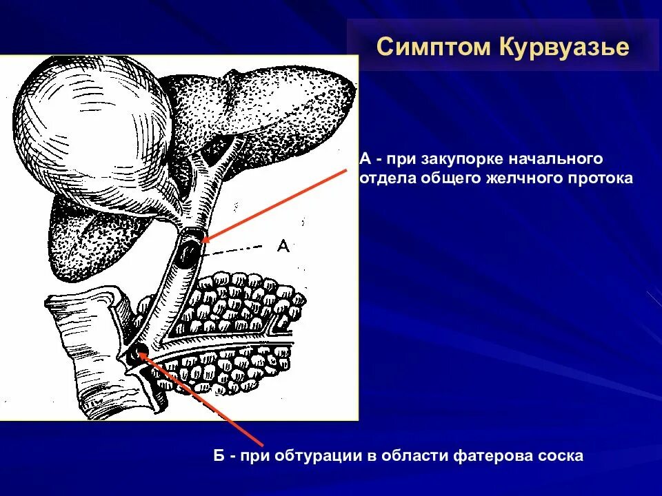 Симптом курвуазье это. Симптом курвуазье при. симптом курвуазье характерен для. курвуазье симптом курвуазье.