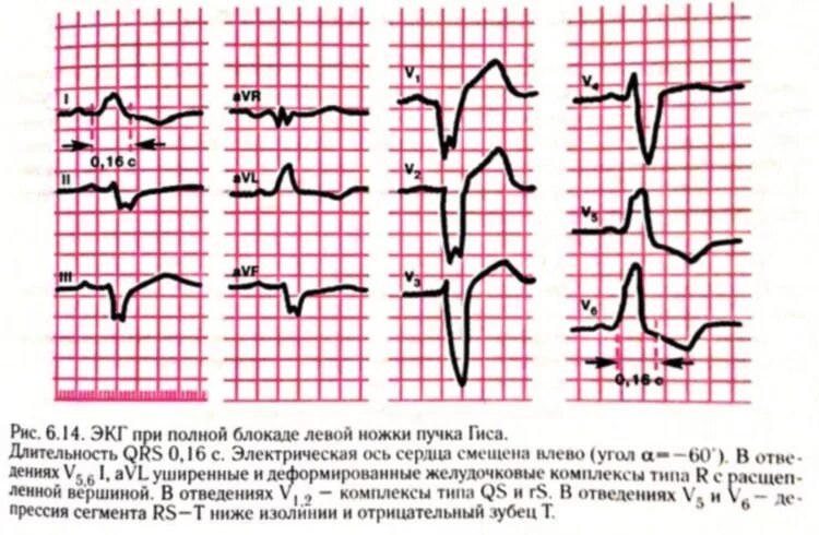 Блокада правого желудочка. Блокада левой ножки пучка Гиса на ЭКГ. Блокада ножек пучка Гиса на ЭКГ. ЭКГ при блокаде левой ножки пучка Гиса. ЭКГ блокада левой ножки пучка.