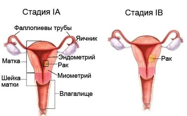 Рак тела матки 1. Степени онкологии матки. стадии онкологии матки. степени онкологии шейки матки.