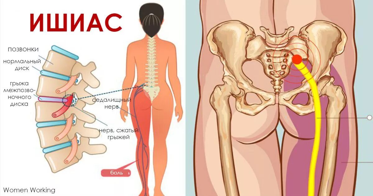 Боли в пояснице симптомы у женщин. Седалищный нерв. Ишиас седалищного нерва. Защемление седалищного нерва упражнения. Гимнастика защемило седалищный нерв.