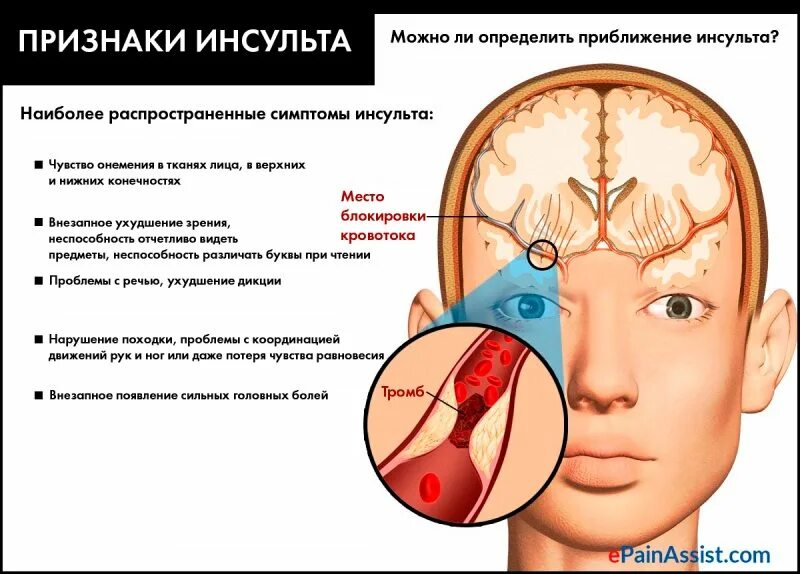 Почему умирают от инсульта. Инсульт. проявления микроинсульта. признаки инсульта. микроинсульт осложнения.