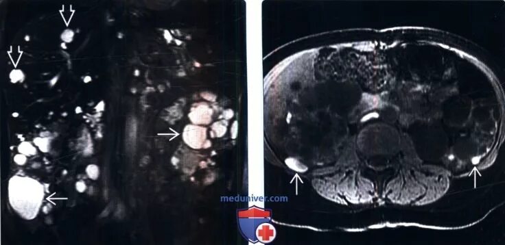Киста печени мрт. Паразитарная киста печени мрт. Аутосомно-доминантный поликистоз почек на кт.