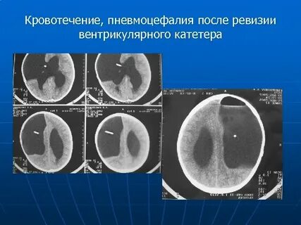 Пневмоцефалия