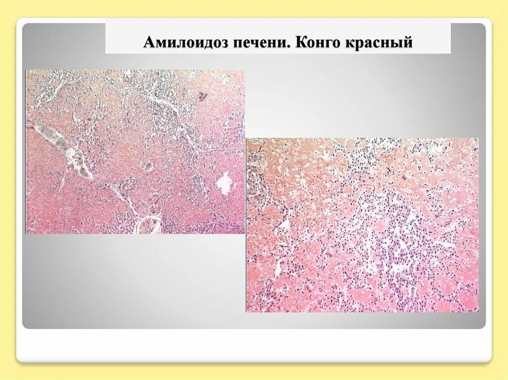 Саговый амилоидоз селезенки. Амилоидоз печени микропрепарат конго красный. амилоидоз селезенки микропрепарат конго красный. амилоидоз печени презентация.