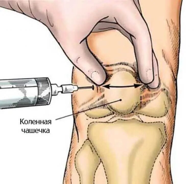 Точки пункции коленного сустава. Техника внутрисуставной инъекции в коленный сустав. Техника пункции коленного сустава топографическая анатомия. Пункция коленного сустава техника точки. В ноги можно обезболить