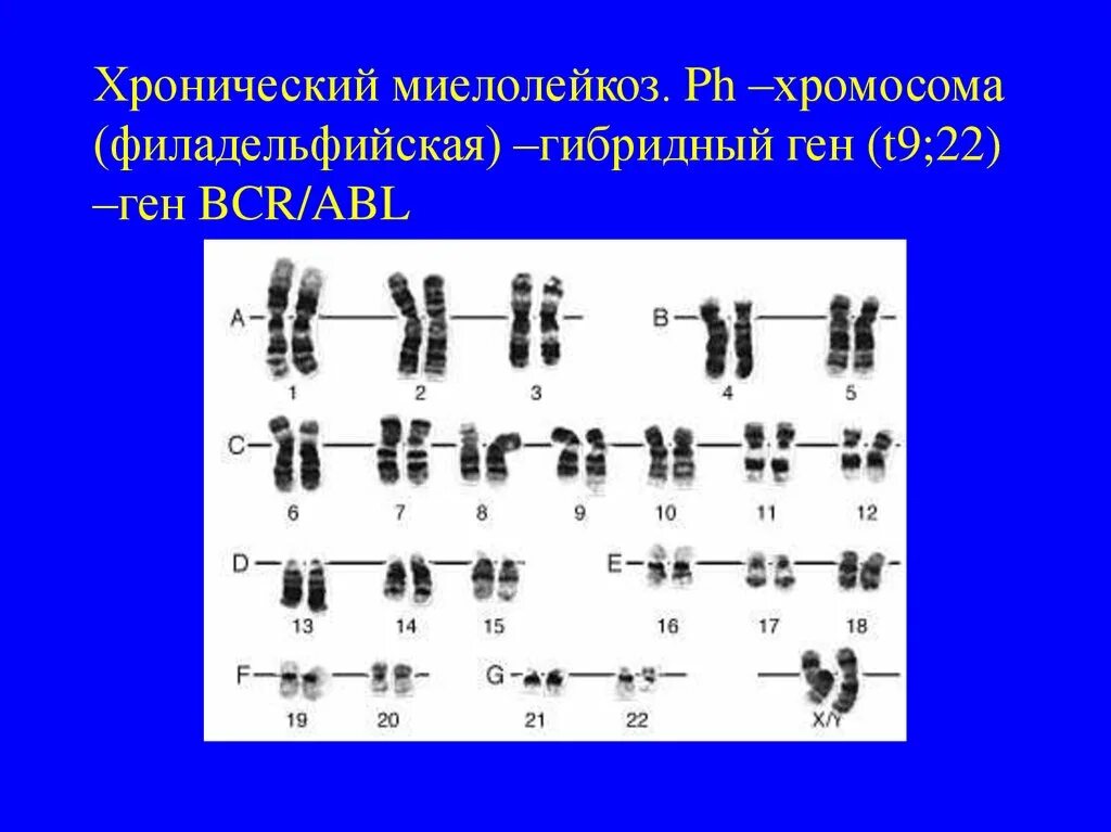 Хронический миелолейкоз хромосомы. Филадельфийская хромосома. Филадельфийская хромосома при хроническом миелолейкозе. Хронический миелолейкоз хромосомы. Синдром хронического миелолейкоза кариотип.