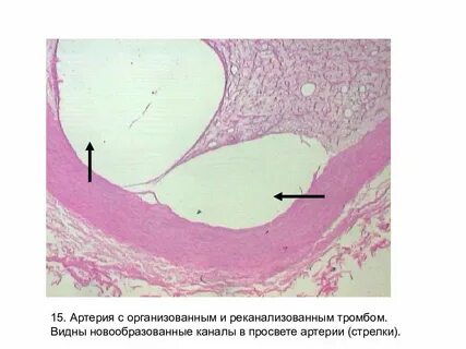 Смешанный тромб микропрепарат