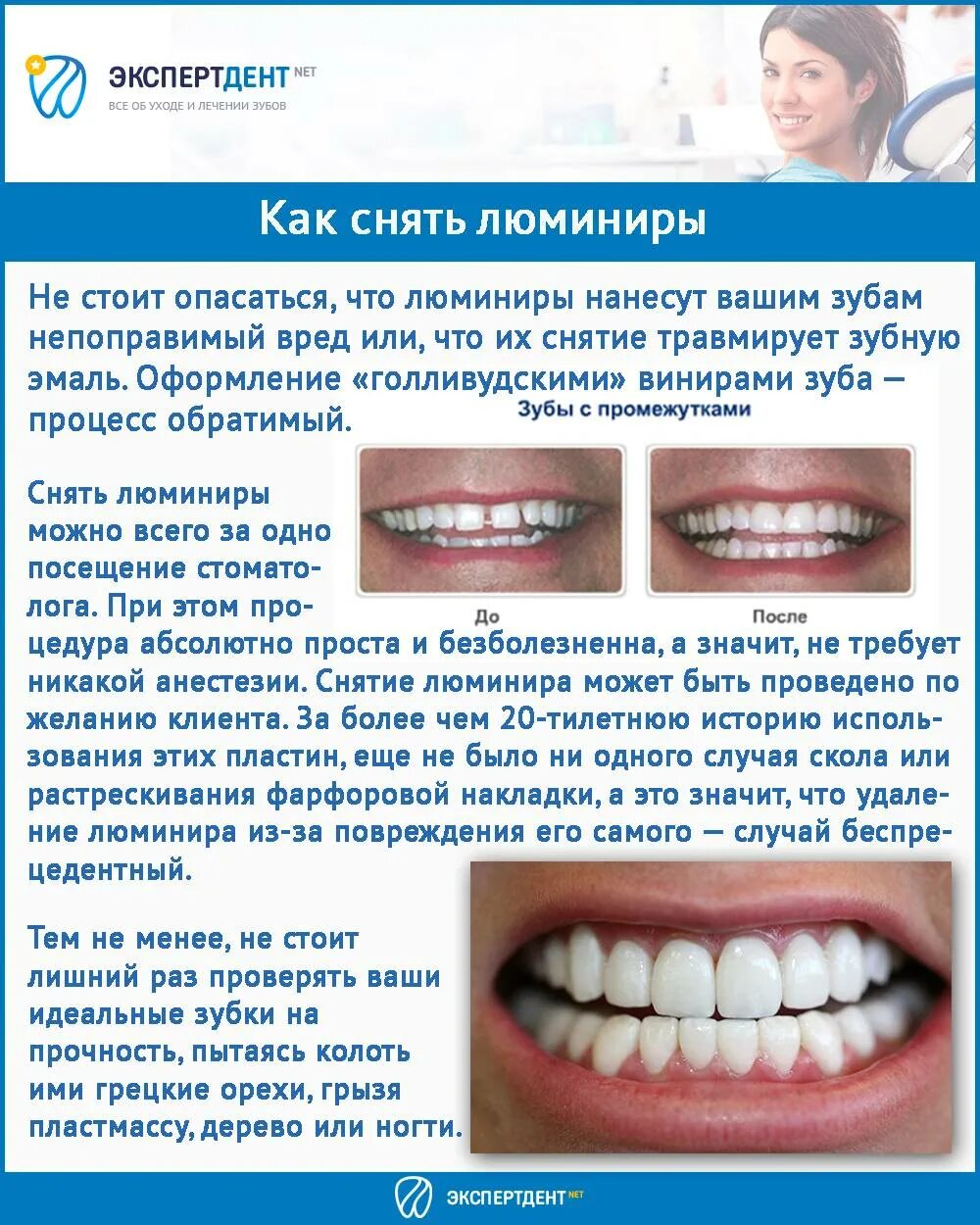 Плюсы и минусы виниров