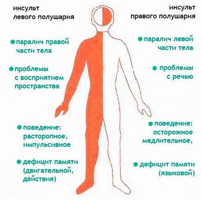 Инсульт парализация левой стороны. Инсульт. Левосторонний ишемический инсульт. Парализовало левую сторону. Геморрагический инсульт симптомы.