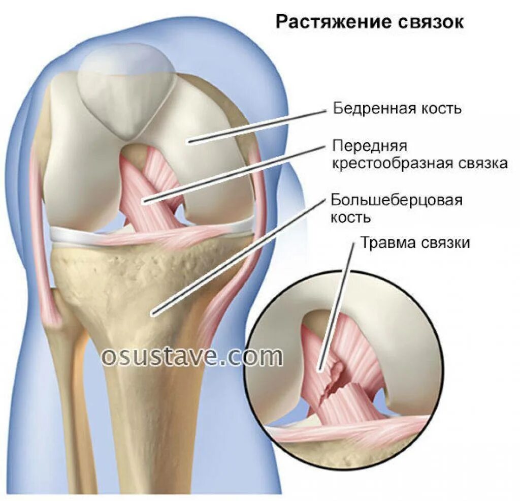 Боль коленной связки. Разрыв связок под коленкой. Связки восстанавливаются. Растяжение крестовидной связки. Растяжение связок колена.