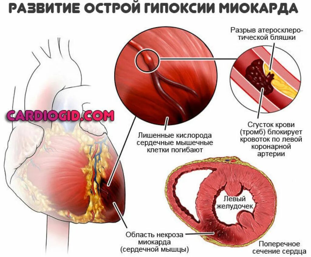Причины развития острого инфаркта миокарда. Обширный инфаркт миокарда. Инфаркт миокарда сердце. Инфаркт Мио Арда. Симптомы микроинфаркта у женщин