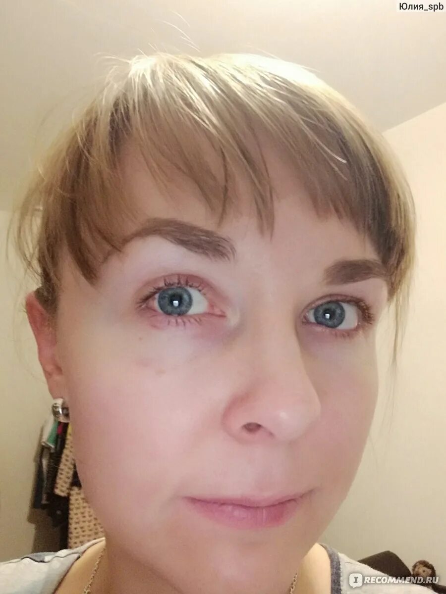 Отзыв исправление косоглазия. Операция косоглазие у взрослых. Сходящееся косоглазие у взрослых. Отзыв исправление косоглазия. Отзыв исправление косоглазия.