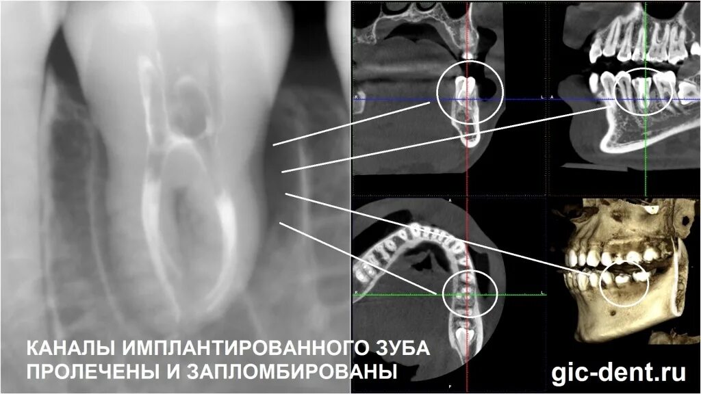 Кт зубов.