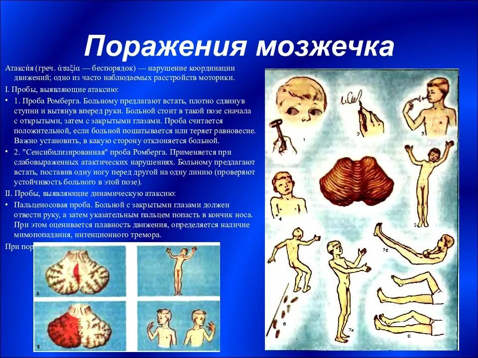 Нарушение функции мозжечка. Мозжечковая атаксия. Исследование функции мозжечка. Мозжечковая атаксия заболевания. Мозжечковая атаксия,нарушение координации движений. Атаксия при поражении мозжечка.