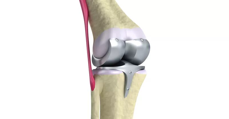 Как выглядит коленного. Коленный эндопротез depuy. эндопротез локтевого сустава depuy. эндопротез коленного сустава депью сигма. эндопротезы коленного сустава производители.